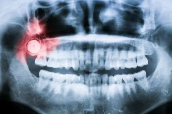 IMPACTED WISDOM TOOTH