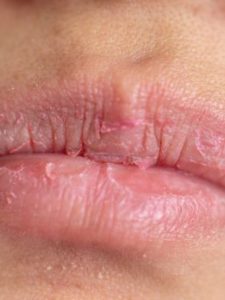 Medications That Cause Dry Mouth