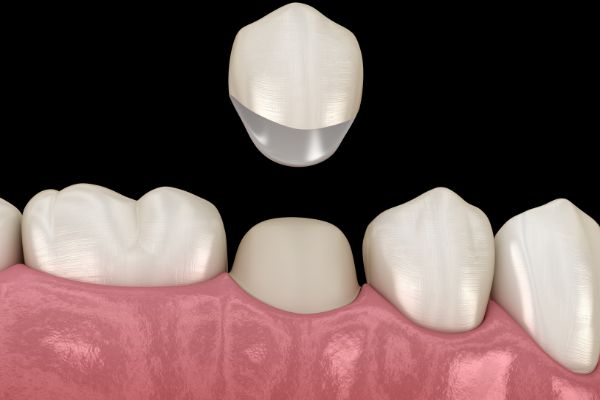 DENTAL CROWNS