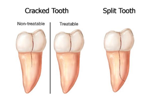 CRACKED OR BROKEN TOOTH PAIN RELIEF