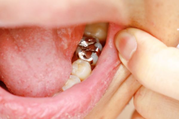 CRACKED OR BROKEN TOOTH PAIN RELIEF