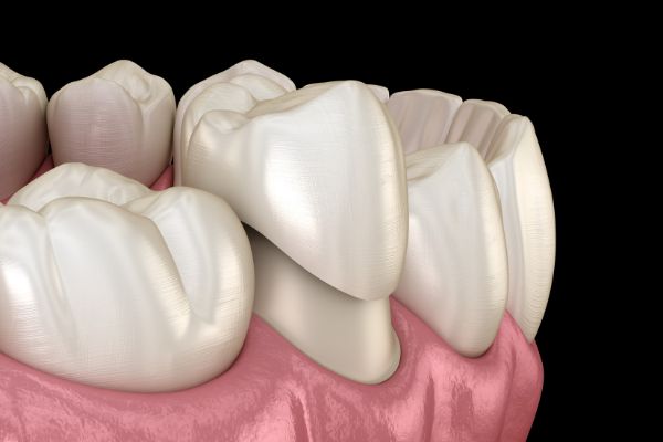 Types of dental Crowns