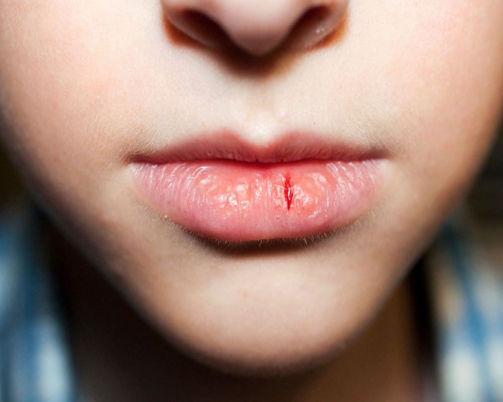 wounded mouth