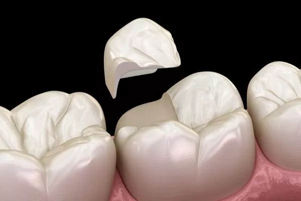 Que son las incrustaciones Inlay