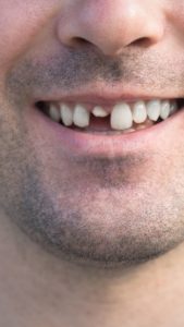 Cracked Or Broken Tooth Pain Relief