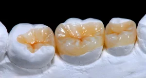 dental inlay
