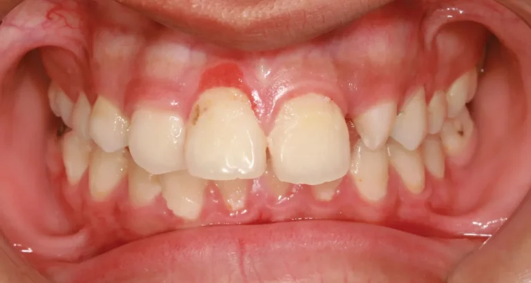 Trench Mouth