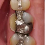 Cracked Or Broken Tooth Pain Relief