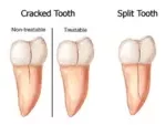 Cracked Or Broken Tooth Pain Relief