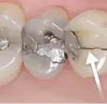 Cracked Or Broken Tooth Pain Relief
