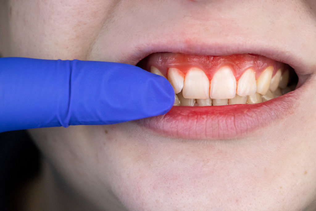 5 IMPORTANT POINTS ABOUT LOOSE TEETH DUE TO GUM DISEASE | Cidentist.com