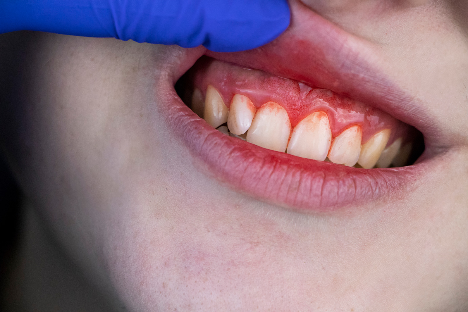 Gum Bleeding and Inflammation Close up
