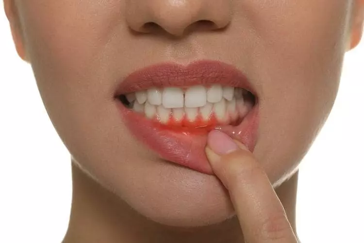Gum Diseases: Signs And Symptoms