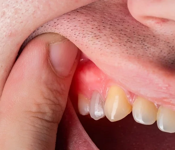 gum-disease