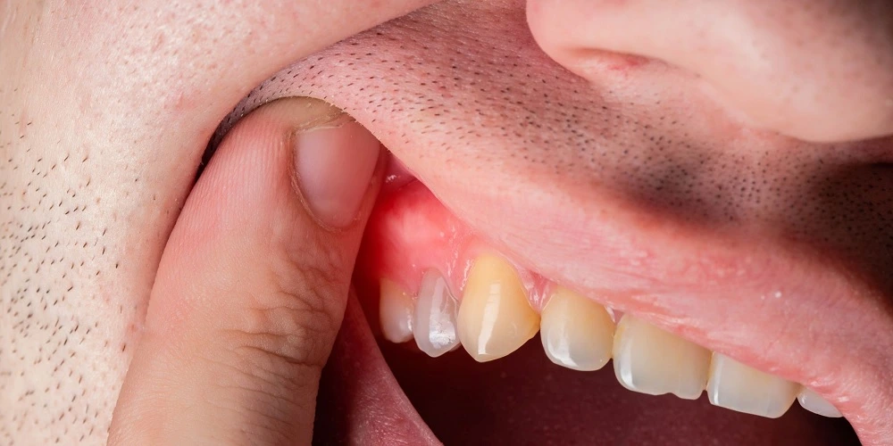 gum-disease