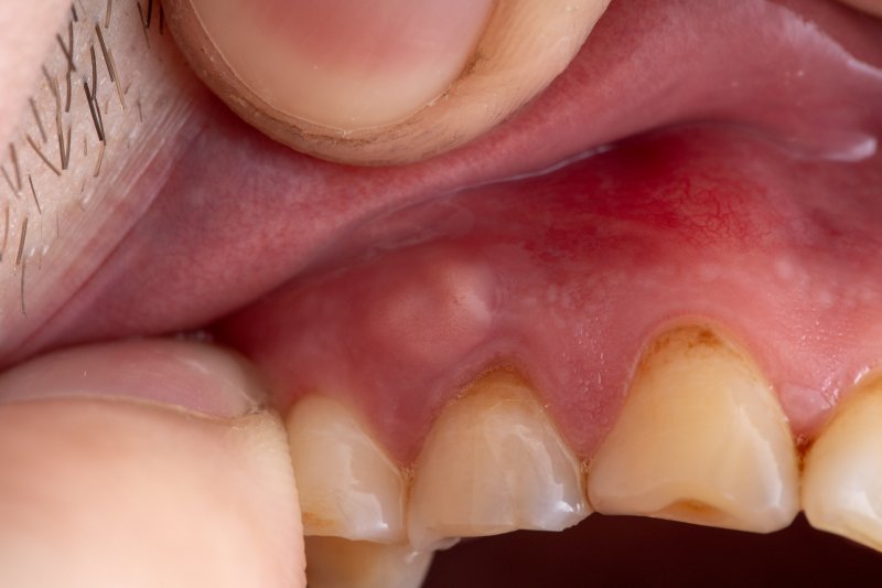 abscess in gums