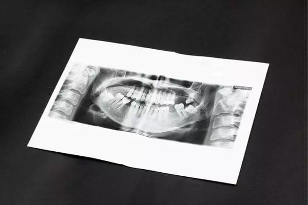 Etapas y causa de la infección dental que se extiende al hueso
