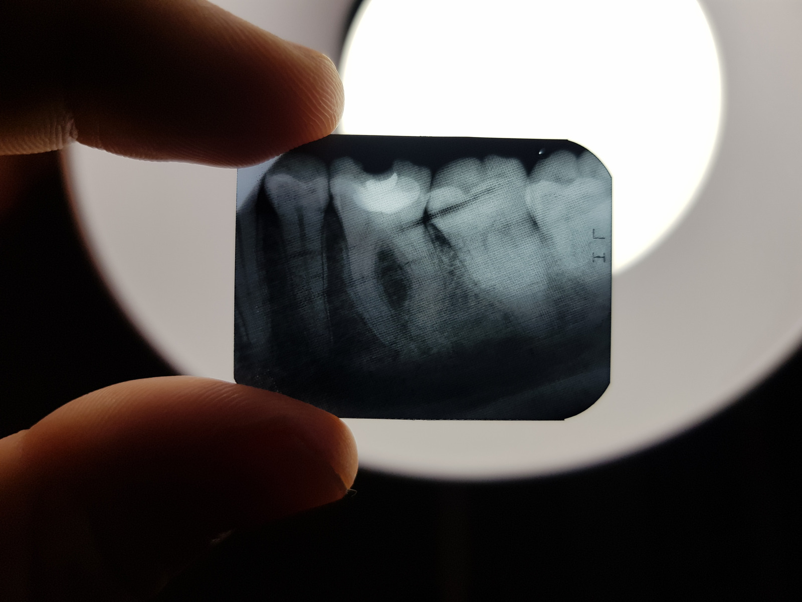 The result of x-ray radiography of the teeth of the oral cavity of the patient to be treated in dentistry