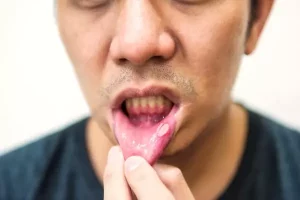 Signos de alerta temprana de cáncer de boca