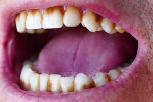 neglected teeth yellowed teeth