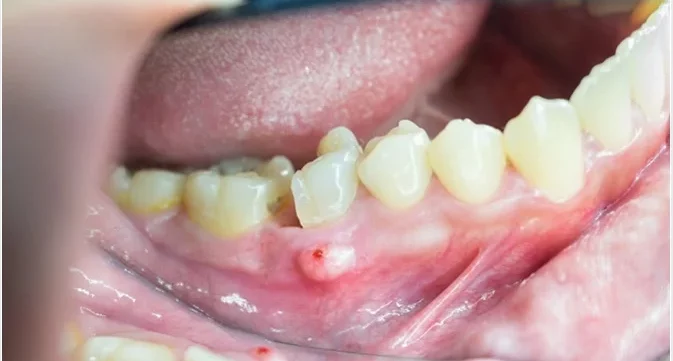 tooth-abscess-spreading