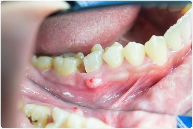 tooth infection spreading to the bone