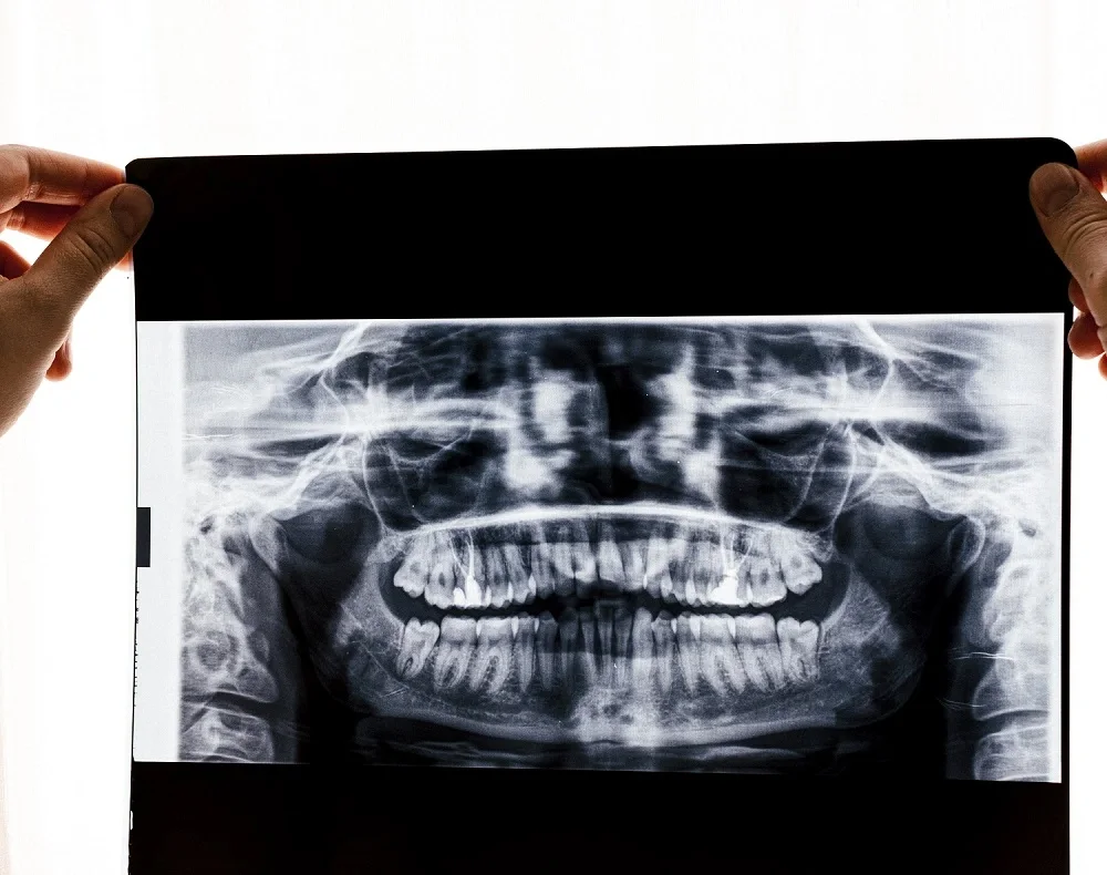 x-ray-of-full-set-of-teeth