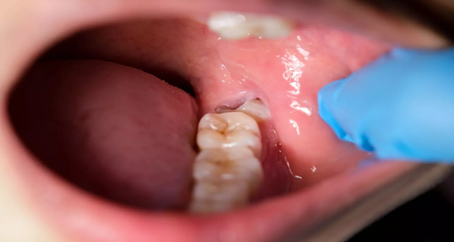 Foods to eat after wisdom teeth removal