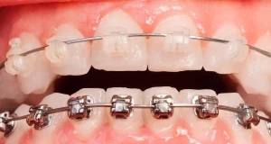 Ceramic vs Metal Braces