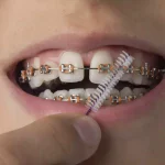 metal-braces