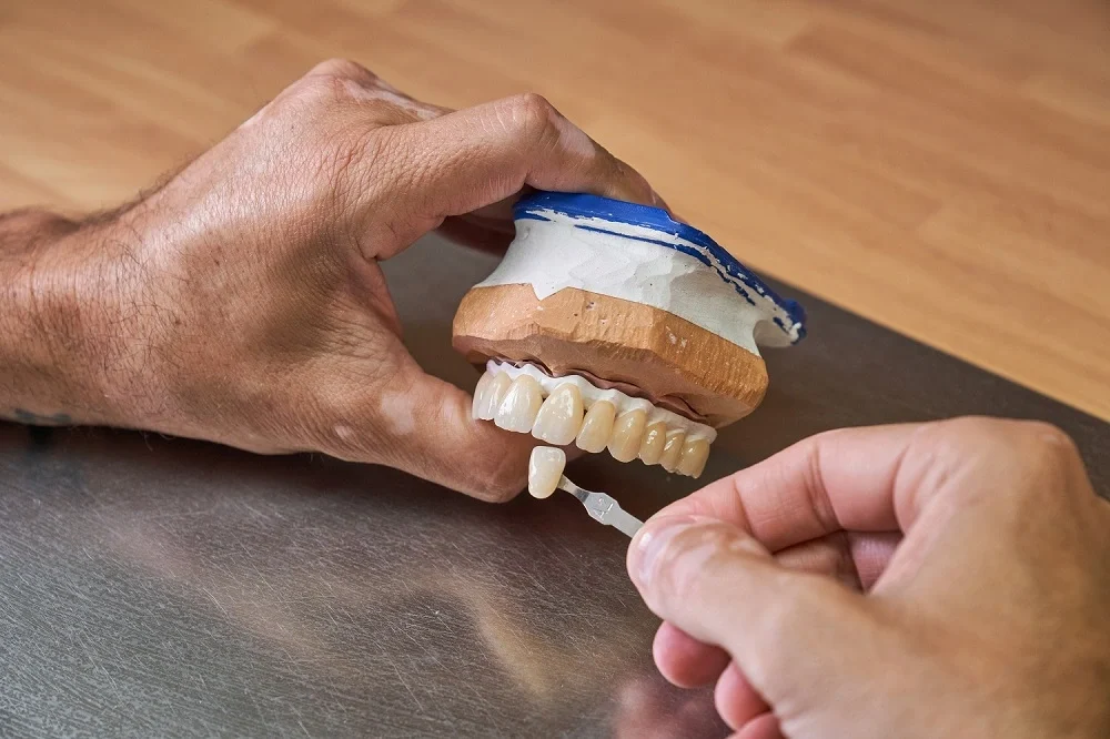 how long do veneers last