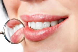 gemas dentales