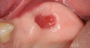 healing wisdom tooth hole