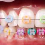 ceramic-vs-metal-braces