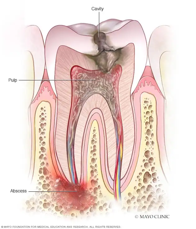 symptoms-of-a-tooth-infection-spreading