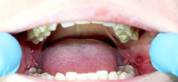 wisdom tooth extraction