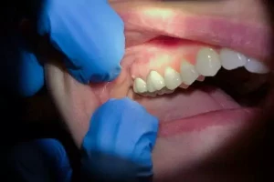 Cómo drenar un absceso dental en casa