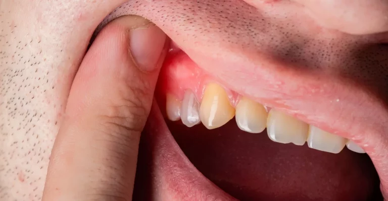 What is a Dental Abscess? (Causes and 3 Treatments Options)