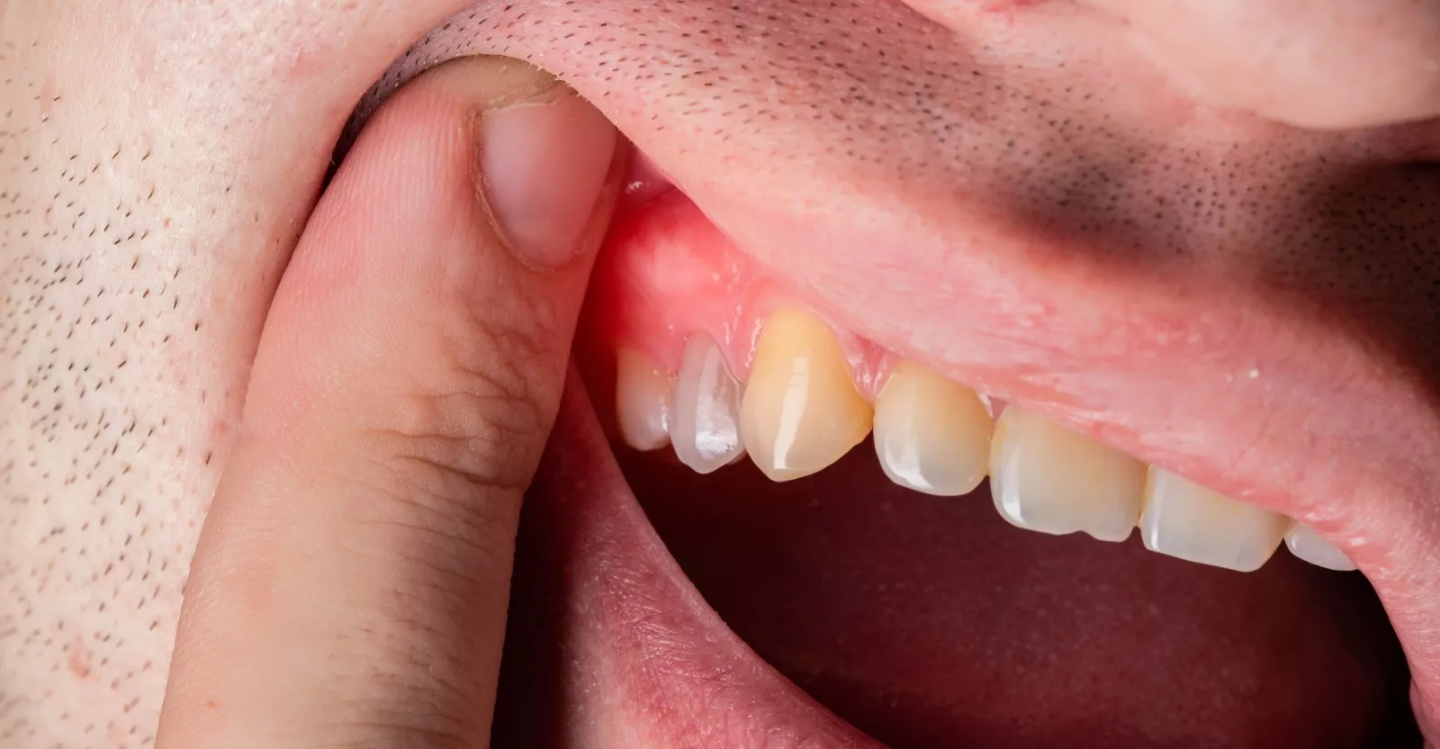 What is a Dental Abscess? (Causes and 3 Treatments Options)