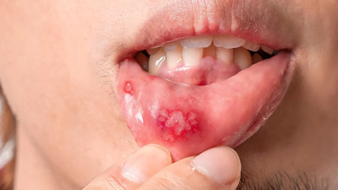 mouth ulcer vs canker sore