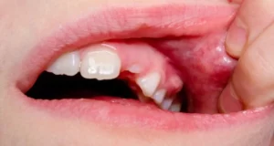 How to drain a tooth abscess at home