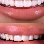 Tipos de restauración dental