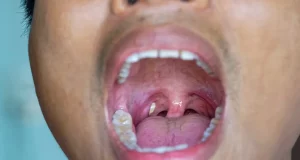 Tonsil Stones