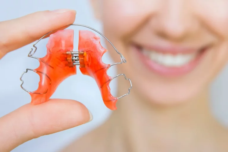 Types of Dental Retainers: 3 Best Options To Choose From