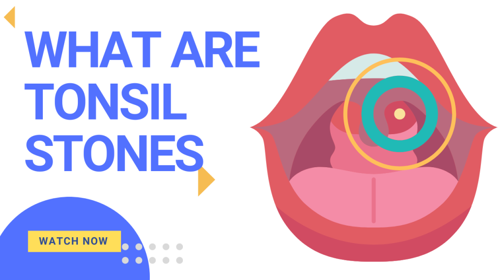 What are Tonsil Stones