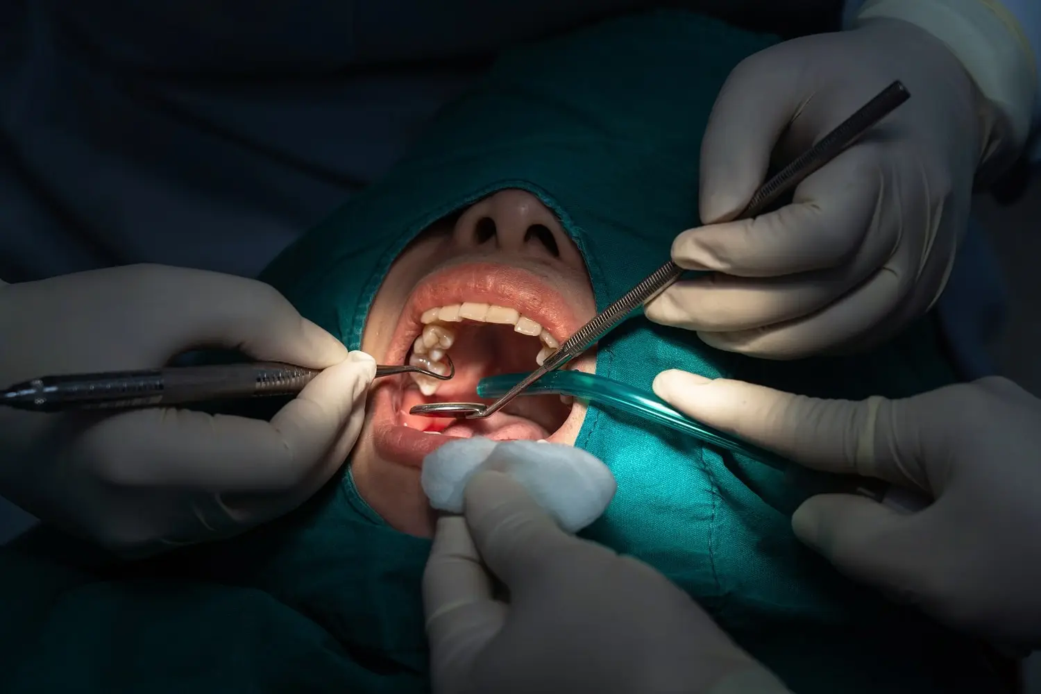 root-canal-operation