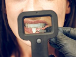 dental-veneers-measurement