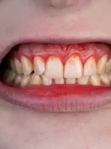 gum recession