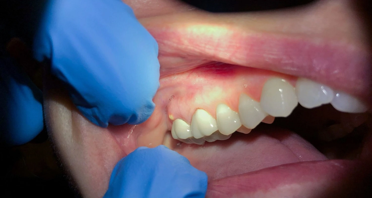 dental abscess