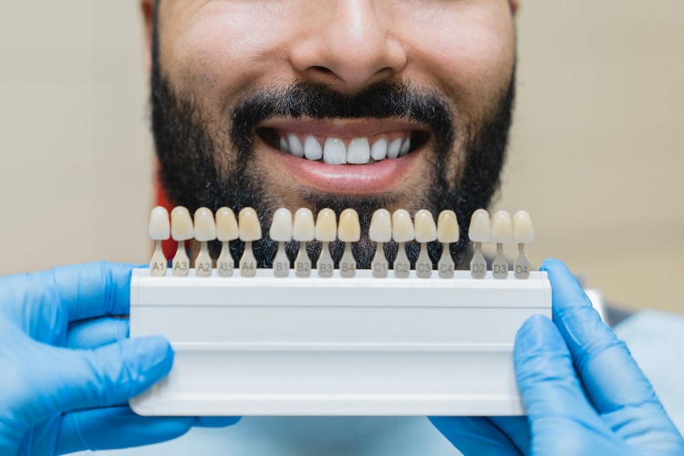 set-of-dental-veneers
